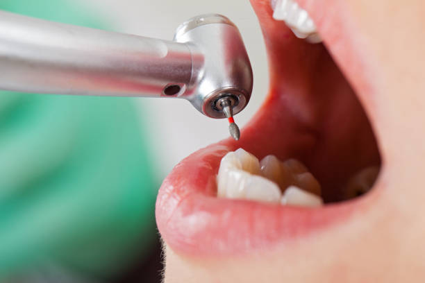 Best Emergency Dental Care for Abscessed Tooth in Rosepine, LA